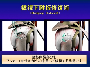 肩関節疾患に対する治療 | 特色ある治療・サービス | 医療法人