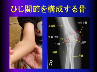 肘関節疾患に対する治療 特色ある治療 サービス 医療法人社団英志会 富士整形外科病院